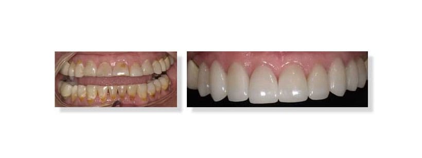 Patient Case: How we transformed a woman’s smile