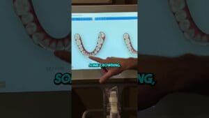 Smile Simulation! Before and After