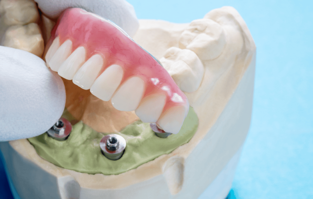 Implant-supported denture model placed on dental implants for a full-arch tooth replacement demonstration.