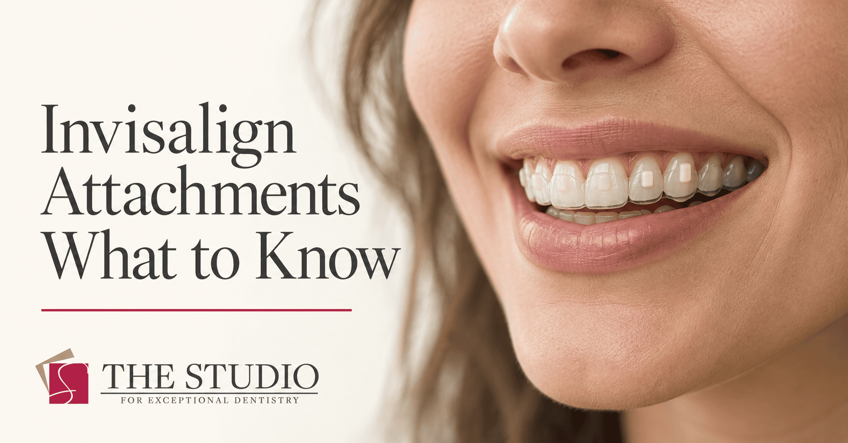 Close-up of clear aligners over tooth-colored Invisalign attachments.